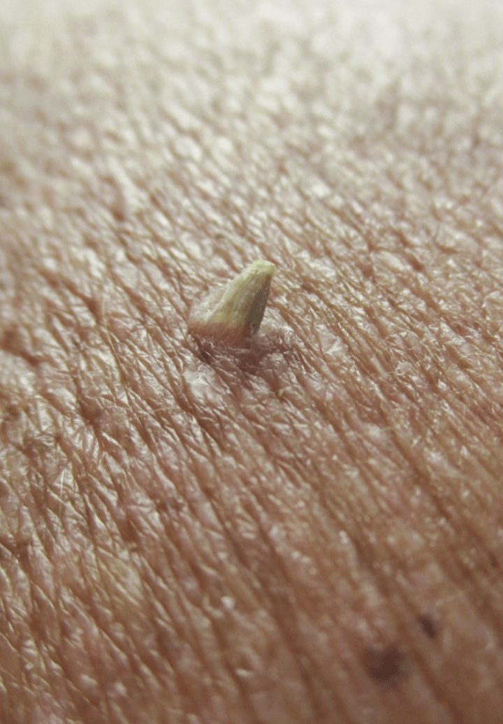 Cutaneous Horn Consultant360